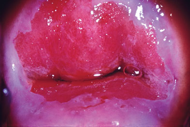 Vulvovaginal Candidiasis - 2015 STD Treatment Guidelines