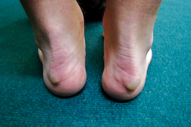 Pictorial Case Study: Heel Pain 