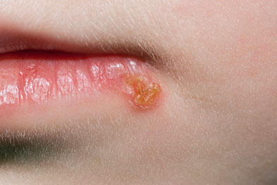 Fenistil (penciclovir) is used to treat herpes simplex virus infection of the lips and face in adults and children over 12 years of age. | SCIENCE PHOTO LIBRARY