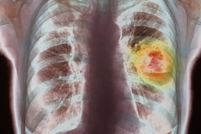 Brazilian study suggests adjustments on the treatment of cancer patients with pneumonia 