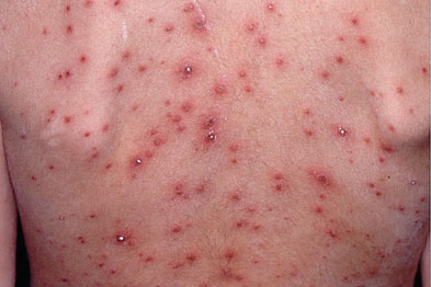 Heat Rash Causes, Symptoms, Treatments, & Prevention - WebMD