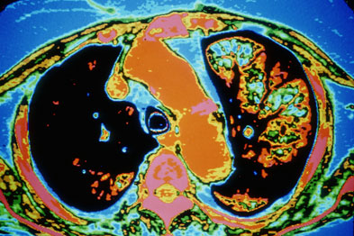copd case studies uk copd case studies uk