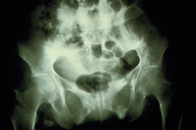Case Study Of Osteomalacia