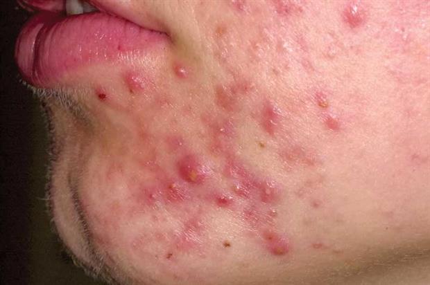 Red itchy bumps with whiteheads - Dermatology - MedHelp