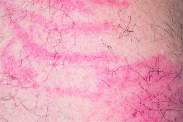 Symptom Management: Managing Chronic Pruritus | GPonline