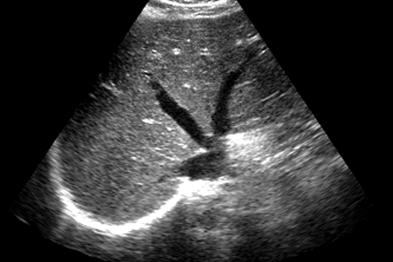 What are some reasons for a liver ultrasound?