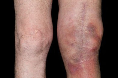 How do you avoid infection after knee surgery?