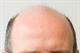 On the agenda - Male baldness link with heart disease