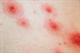 The Basics - Antenatal viral infections