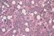Haematology - Myelofibrosis