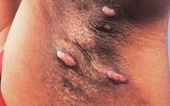 Hidradenitis suppurativa (HS) - NHS