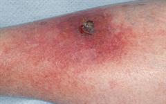 New cellulitis treatment guidance published | MIMS online