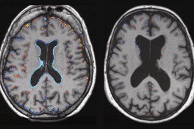 Viewpoint - Vitamin B And Cognitive Decline | GPonline