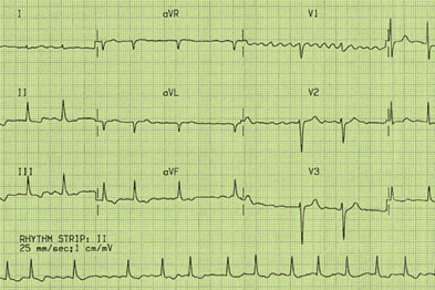 Clinical Review: Atrial fibrillation | GPonline