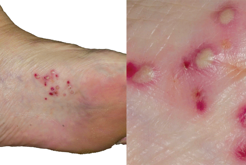 Differential diagnoses Skin conditions of the feet