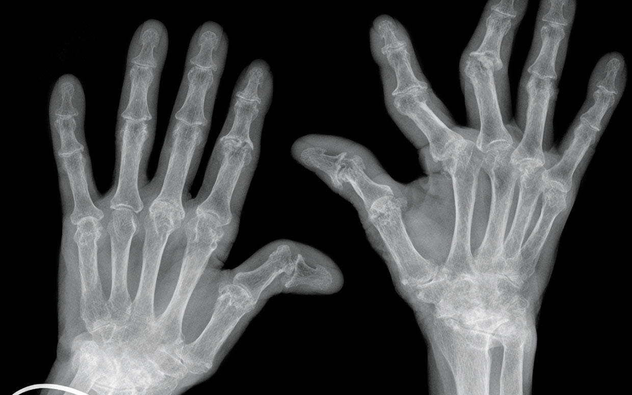 Rheumatoid arthritis: clinical review | GPonline