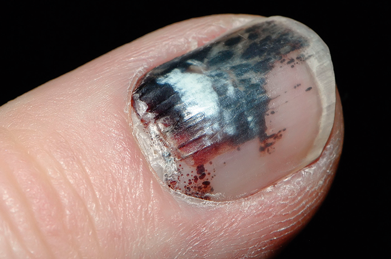 Differential diagnoses Painful nails