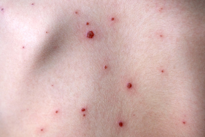 Chickenpox jab should be added to UK child vaccine programme, says JCVI