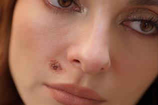 Woman with melanoma mark on her face