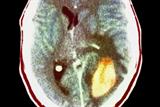 CT scan showing a rapidly growing glioma (yellow) (Photograph: SPL)