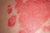 Approximately 2% of the UK population is affected by psoriasis (Photograph: SPL)