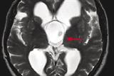 Arachnoid cyst of the third ventricle causing secondary narcolepsy (Photograph: Author)