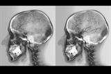 Stroke centres were associated with more frequent use of thrombolysis (after thrombolysis, right) (Photograph: SPL)