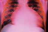 Cardiomyopathy may be a cause of heart failure (Photograph: SPL)