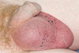 Inflammation and erythema due to epididymo-orchitis (Photograph: SPL)