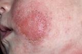 Infection of atopic eczema will exacerbate the condition and should be treated promptly