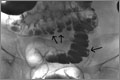 Barium enema demonstrating diverticulosis (arrows) 