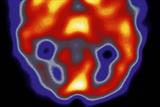 Scan of a patient's brain during a migraine; grey area (lower left) shows low brain activity (Photograph: SPL)