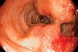 Colorectal cancer: resection is usually the treatment of choice (Photograph: SPL)