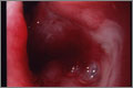 Duodenal ulcer in the duodenal bulb, a possible cause of anaemia (pictures : dr warren hyer)