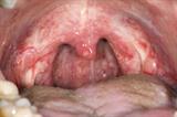 Sore throat: safe and effective OTC analgesics are already available