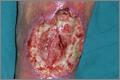 Ischaemic ulcer