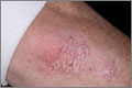 Psoriasis can occur anywhere but most commonly affects the extensor surfaces, such as knees and elbows