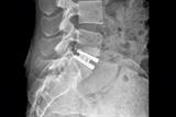 X-ray showing disc prosthesis in the lumbar spine (Photograph: SPL)