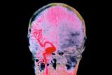 Stroke: many AF patients do not receive correct treatment (photo: SPL)