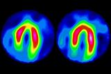 Scans showing heart at rest (right) and during ischaemic exercise (left)