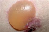 Over time the tense blisters can become purulent and haemorrhagic