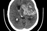 Without brain imaging, such as CT scanning, it is impossible to determine whether a stroke is ischaemic or haemorrhagic (above) (Photograph: Dr Jonathan Birns)