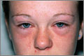 Periorbital oedema and allergic conjunctivitis as a result of hay fever