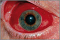 Blood from a ruptured vessel escapes below the conjunctiva (SPL)