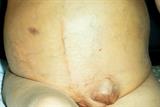 Patient with ascites and hernia caused by cirrhosis, a complication of long-term alcohol misuse (Photograph: SPL)