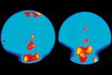 Radioactive tracer (orange/red) shows tumour cells around the parathyroid gland (Photograph: SPL)