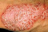 Male patients with psoriasis were shown to have a higher incidence of erectile dysfunction (Photograph: SPL)