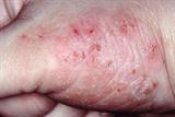 Atopic eczema reduces the barrier function of the skin