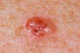 Basal cell carcinoma: non-melanoma skin cancers raise malignancy risk