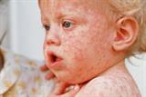 Measles: national MMR campaign launched (photo: SPL)